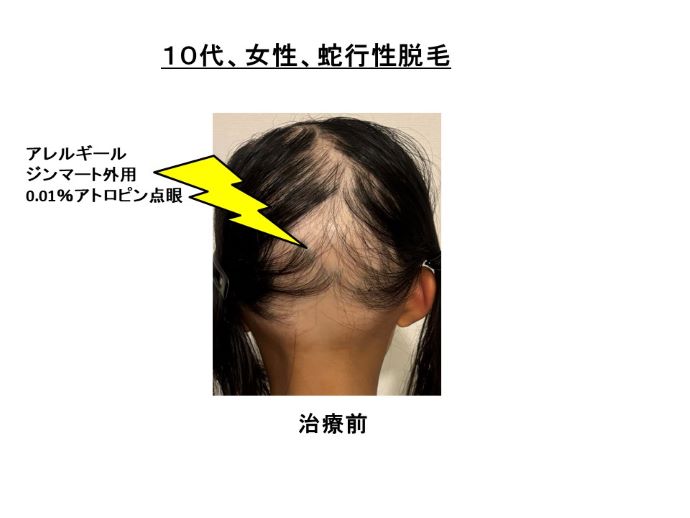 円形脱毛症　病院